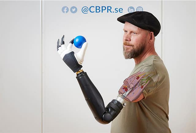 Above Elbow Amputee Controls Individual Bionic Fingers |